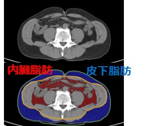 全身検査:胸腹部CT検査 写真01